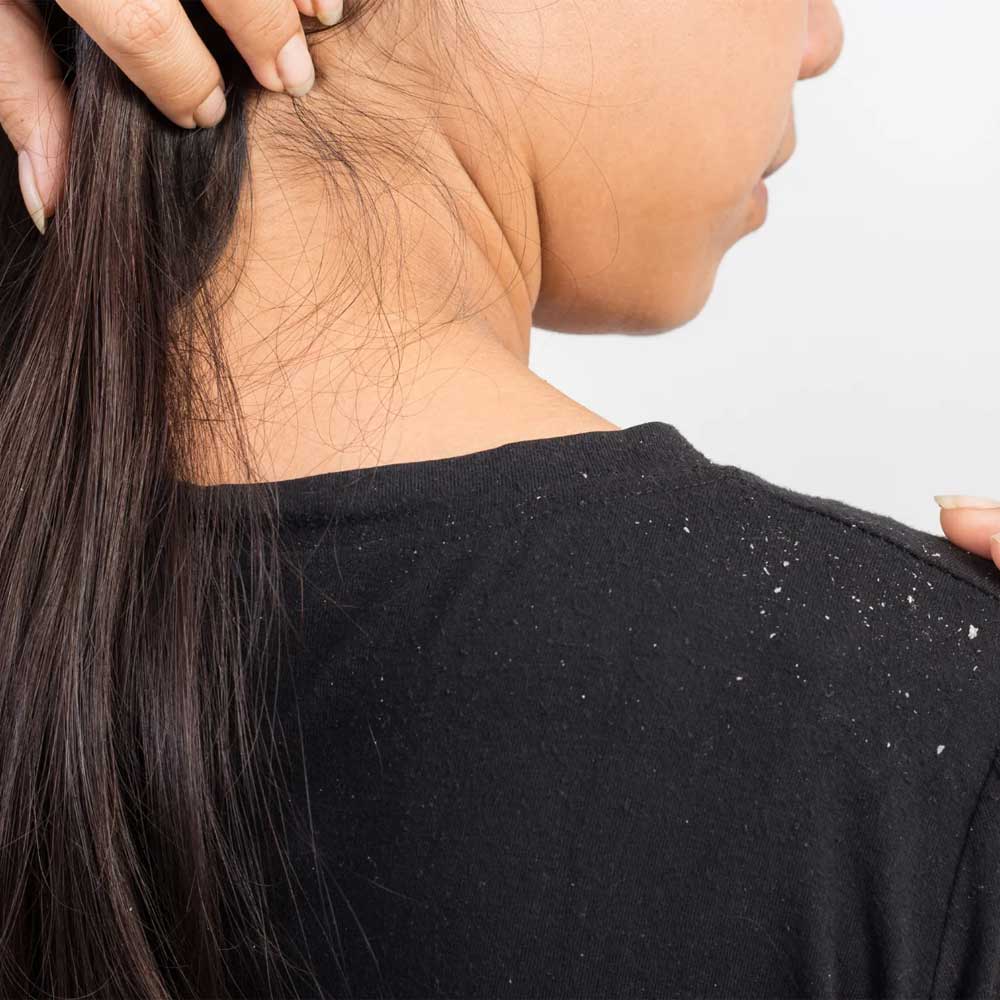 ساده ترین روش های درمان شوره مو
